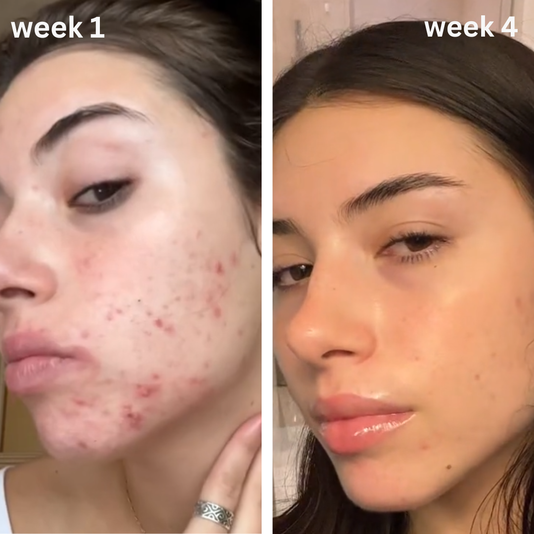 Turmeric & Kojic Acid Acne Scar Cream