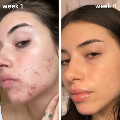 Turmeric & Kojic Acid Acne Scar Cream