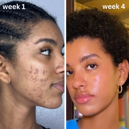 Turmeric & Kojic Acid Acne Scar Cream