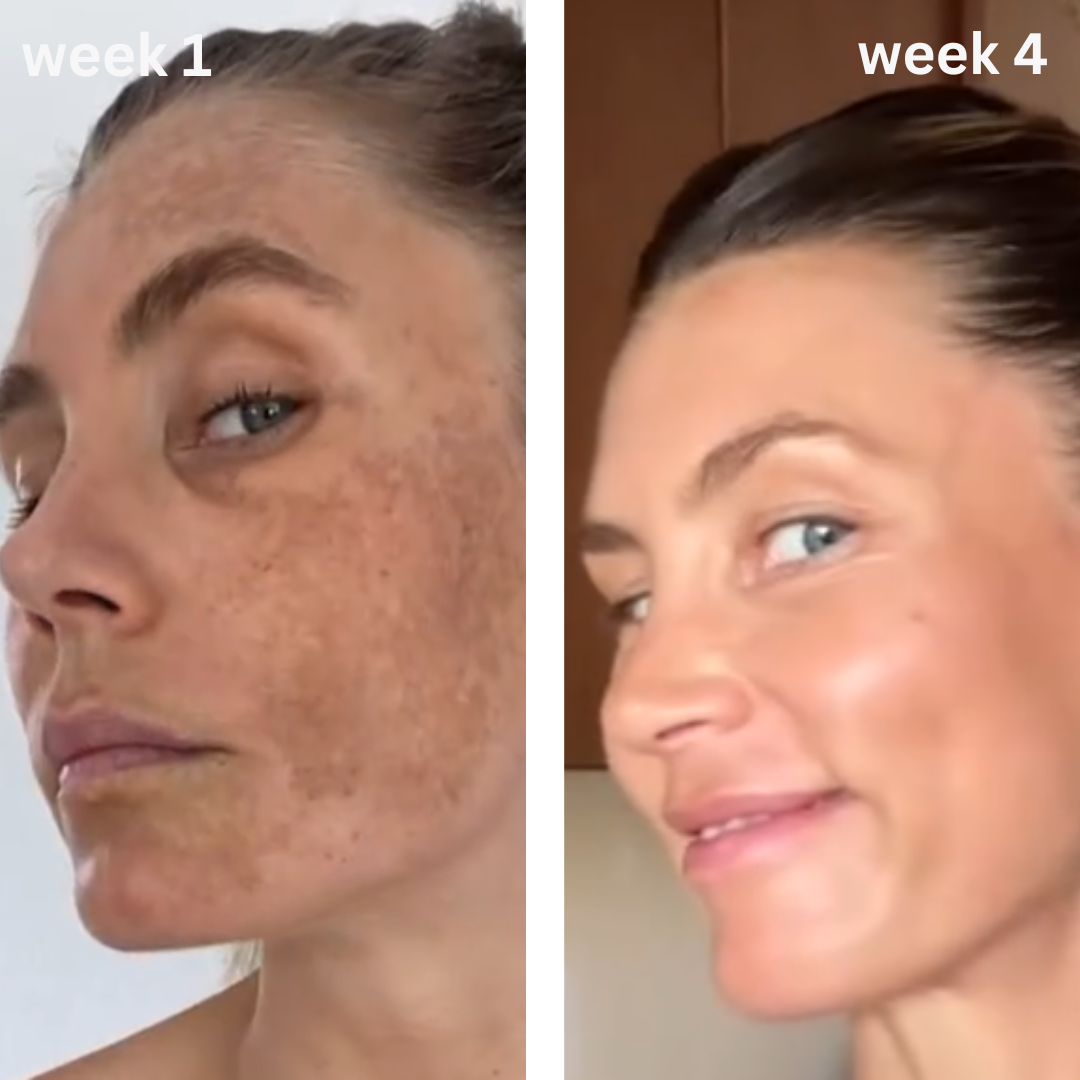 Turmeric & Kojic Acid Acne Scar Cream